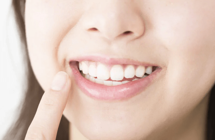 歯列矯正は1か月でどれくらい動く？動きやすい人の特徴を紹介