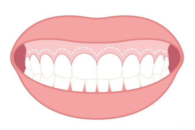 歯列矯正をすると歯茎は引っ込む？3つの治療方法を紹介